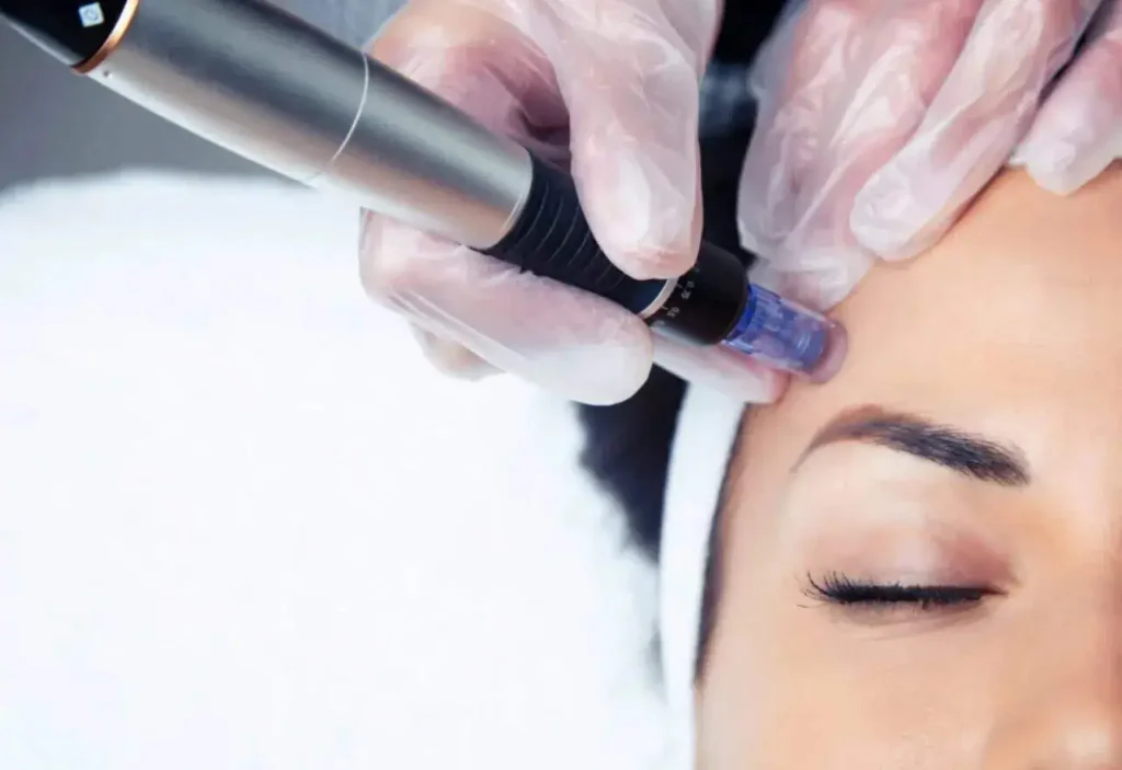Close-up van microneedling bij Nash Fit met Zalm DNA PDRN huidbooster